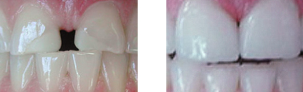 Before and after empress crowns and veneers