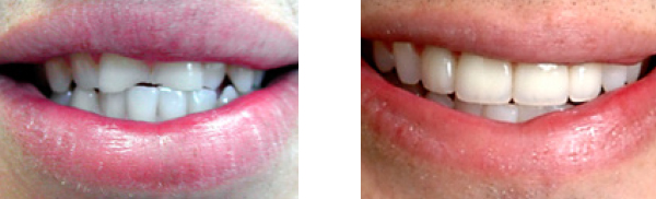 before and after of empress crowns and veneers